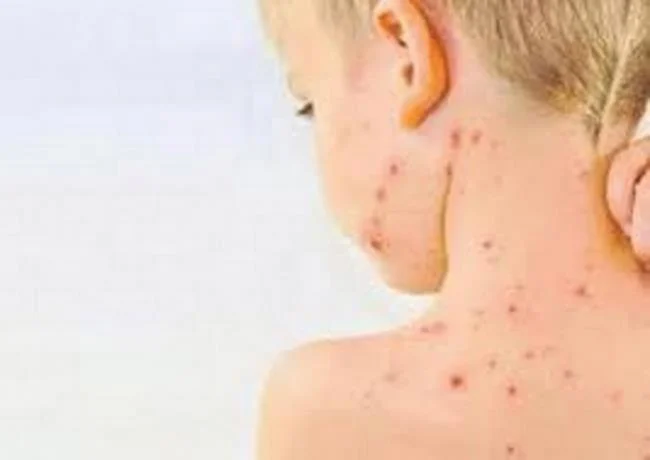 OMS alerta de brotes de sarampión en el mundo tras disminución de tasa de vacunación