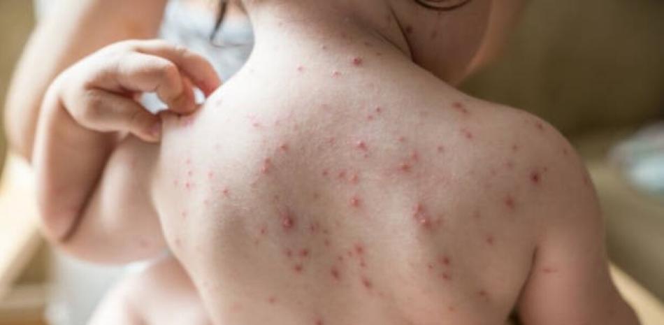 El país registra 3,693 casos de varicela en lo que va de año