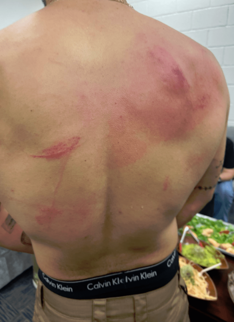 Bad Bunny muestra su espalda con arañazos y hematomas tras pelea en WWE