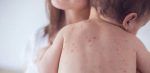 Salud Pública emite alerta epidemiológica por sarampión