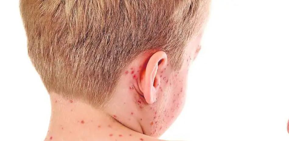 Presidente del Colegio Médico llama a vacunarse contra el sarampión