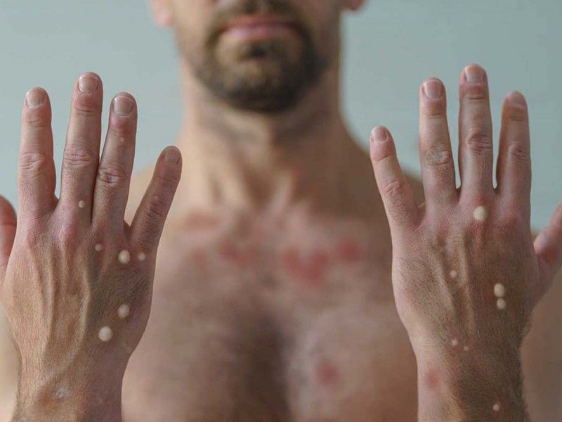 La OMS registra más de 34.000 casos y 138 muertes de viruela símica en lo que va de 2025