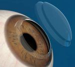 Con 370 trasplantes de córneas en un año, activarán bancos de donación en dos hospitales