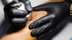 La radioterapia guiada por superficie permite evitar los tatuajes permanentes en pacientes de cáncer
