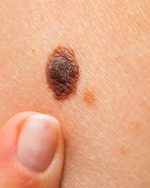 Melanoma maligno: el cáncer que en silencio va afectando la piel