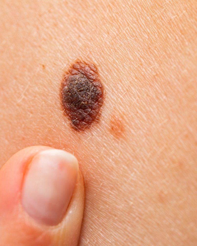 Melanoma maligno: el cáncer que en silencio va afectando la piel