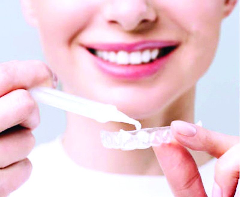 Las carillas dentales ¿Un lujo o una necesidad?